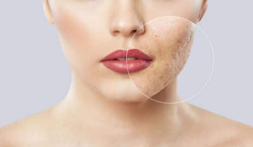 woman with acne scarring