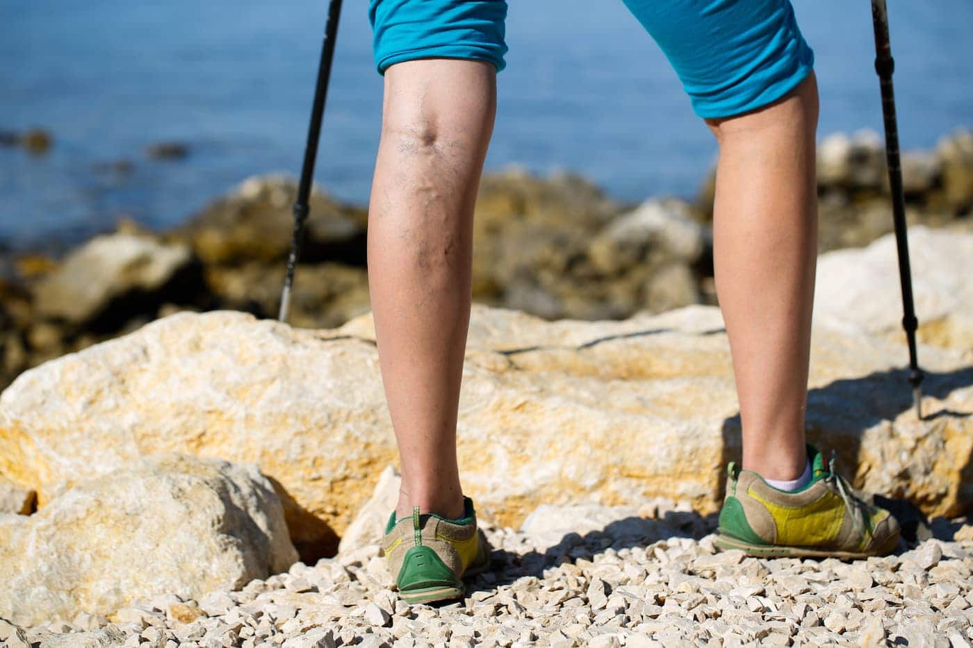 4 Potential Causes of Varicose Veins And What You Can Do To Reduce Your Risk