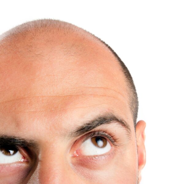 Are Hair Transplants For Men Safe, How Much Do They Cost, And Do You Qualify To Get One?